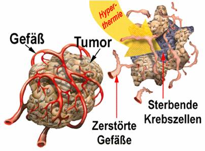hyperthermie, künstliches Fieber, Krebsforschung, Gregor Schäfer